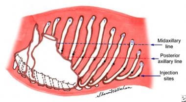 Lateral intercostal block along the posterior axil