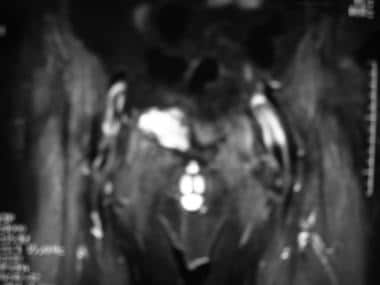 T2-weighted MRI shows high-signal-intensity lesion