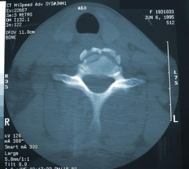 C5压缩性骨折轴位CT扫描。完整的米