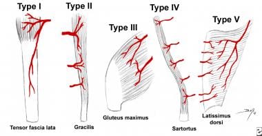 Patterns of muscle flap vascular anatomy. Type I -