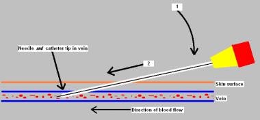 Once needle has entered vein, catheter-over-needle