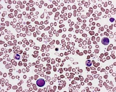 Peripheral smear from a patient with agnogenic mye