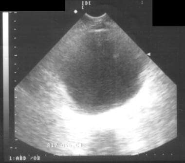 Ultrasound image of distended urinary bladder. 