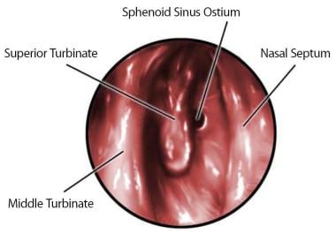 Expected location of the sphenoid ostium. 
