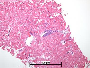 tissue rejection