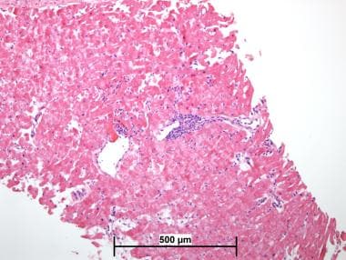 tissue rejection