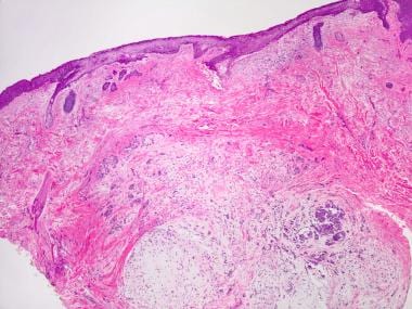 pleomorphic adenoma pathology