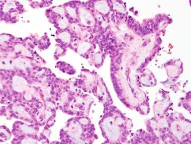 Myxopapillary ependymoma. This image contains cell