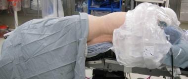 The patient is placed laterally and padded with th