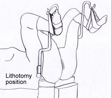 Lithotomy position 