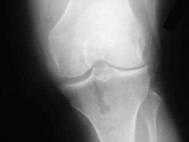 Osteoarthritis of the knee, Kellgren stage III. 