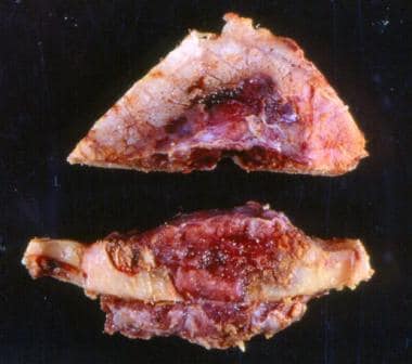 Grossly, angiosarcomas show a reddish-brown color 