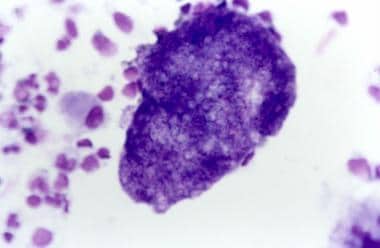 Diff-Quik stain demonstrating Pneumocystis jirovec