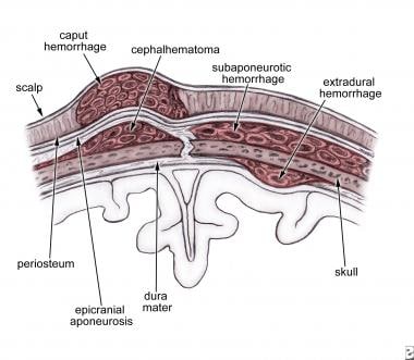 Subaponeurotic hemorrhage