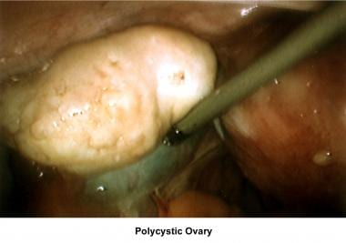 Infertility. Polycystic ovary. Image courtesy of J