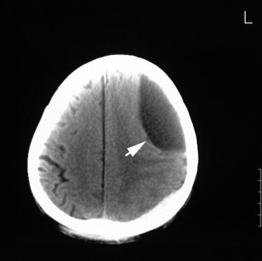 Unenhanced CT scan of the head in a 26-year-old ma