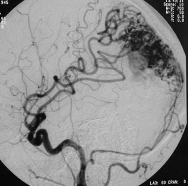 A lateral left carotid angiogram demonstrating a m