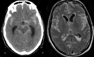 Noncontrast CT scan was performed emergently in th