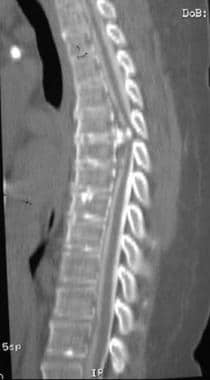 矢状面重组CT脊髓图显示一个大的c