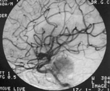 This angiogram of the internal carotid artery demo