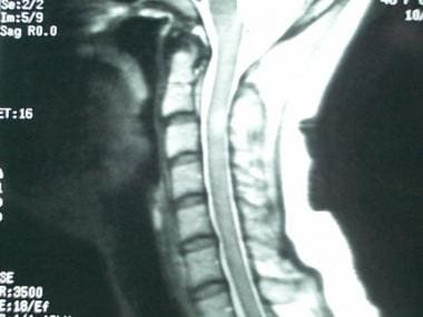 Imaging Of The Spine In Multiple Sclerosis Practice Essentials Computed Tomography Magnetic Resonance Imaging