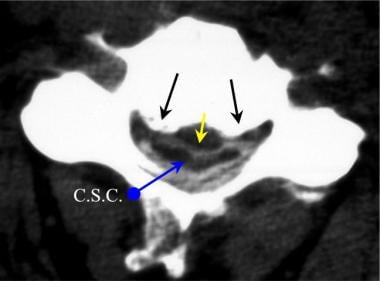 Axial computed tomography (CT) image from a CT mye