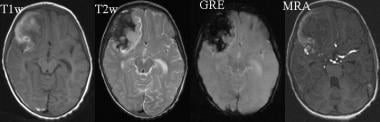 MRI images show an extensive subarachnoid hemorrha