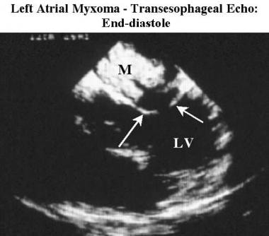 Transesophageal echocardiogram obtained at end-dia