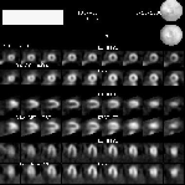 Compared with radionuclide images of blood deliver