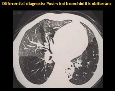 High-resolution CT (HRCT) in a patient after viral