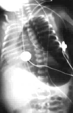 Left-sided tension pneumothorax in an infant. 