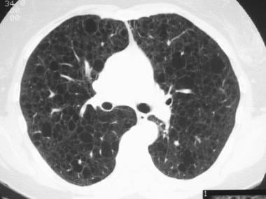 Lymphangioleiomyomatosis。高分辨率CT