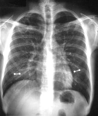 This chest radiograph shows bilateral upper-lobe p
