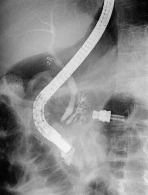 ERCP of a patient with pancreas divisum. Injection