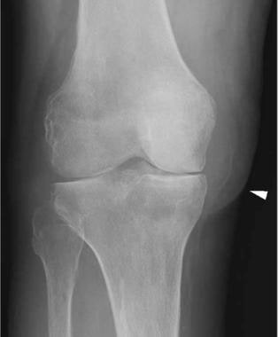 Anteroposterior radiograph of the knee shows unifo