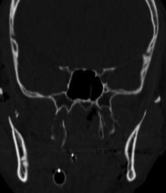 Bilateral pterygoid fractures. 