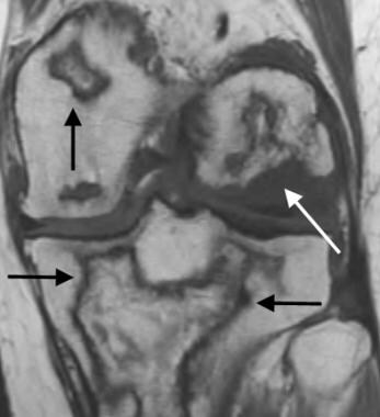 Coronal T1-weighted MRI of the knee in a renal tra