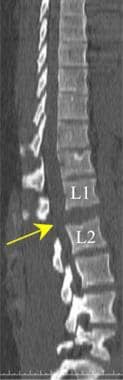 Lumbar spine trauma. Sagittal reformatted CT image