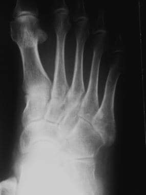 Fractured metatarsals. Transverse fracture at the 