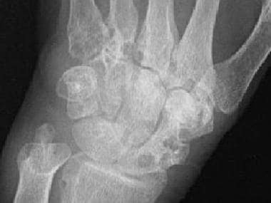 Well-defined bony erosions in the carpal bones and