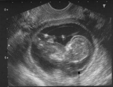 Longitudinal prenatal ultrasonogram shows nuchal t