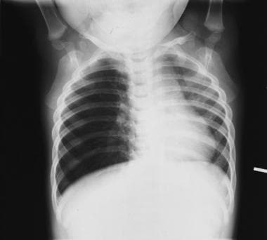 Expiratory chest radiograph in a 12-month-old boy 