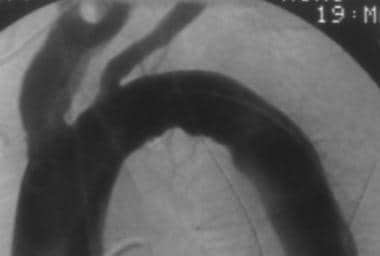 Aorta, trauma. Left anterior oblique (60°) angiogr