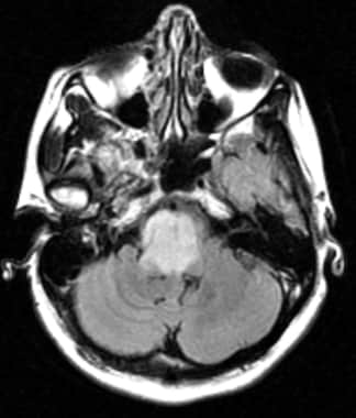 Gliomas - Sự thật về khối u não và những bức ảnh đẹp về gliomas sẽ khiến bạn trầm trồ. Khám phá những chuyển động tuyệt vời của khối u và cách mà nó ảnh hưởng đến cuộc sống của bạn.