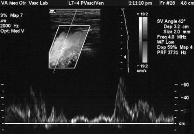 Superior vena cava syndrome (case 1, cont'd). Sono