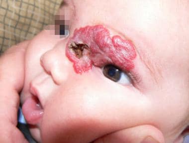 Ulceration of infantile hemangioma.