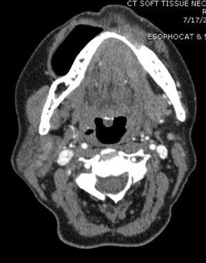 Computed tomography scan (axial) showing squamous 