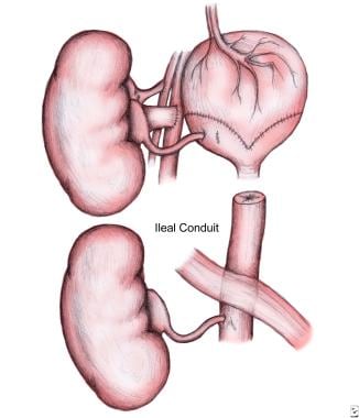 Anastomosis of kidney transplantation. Ureter to (