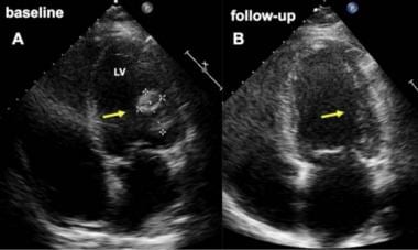 Pericardial cardiomyopathy. Baseline (A) and follo