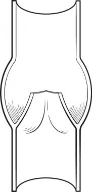 Venous Insufficiency: Background, Anatomy, Pathophysiology